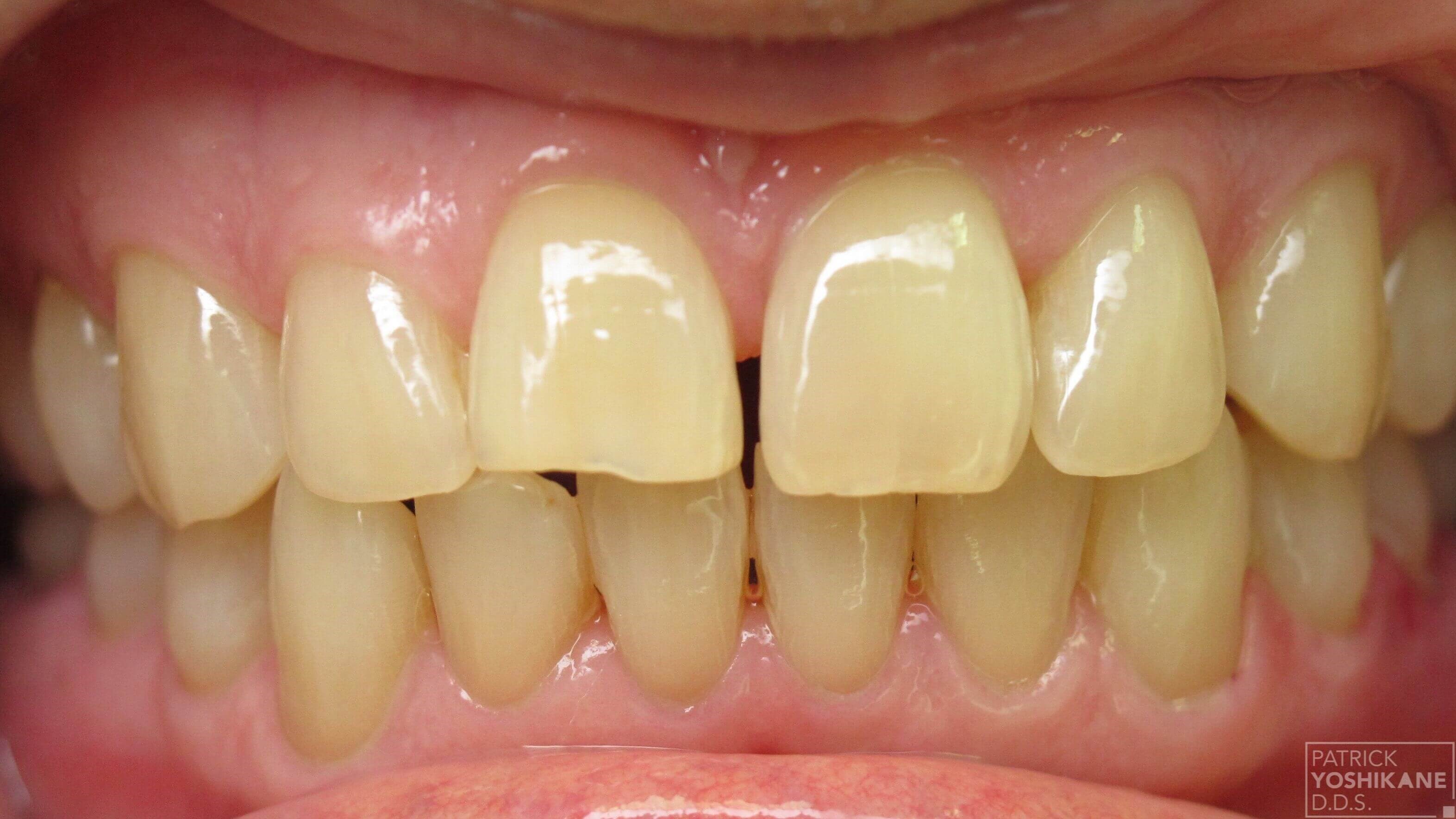 Dental crowns Before Dental crowns Before