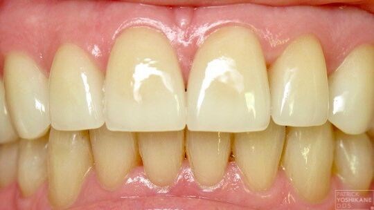Dental crowns After Dental crowns After