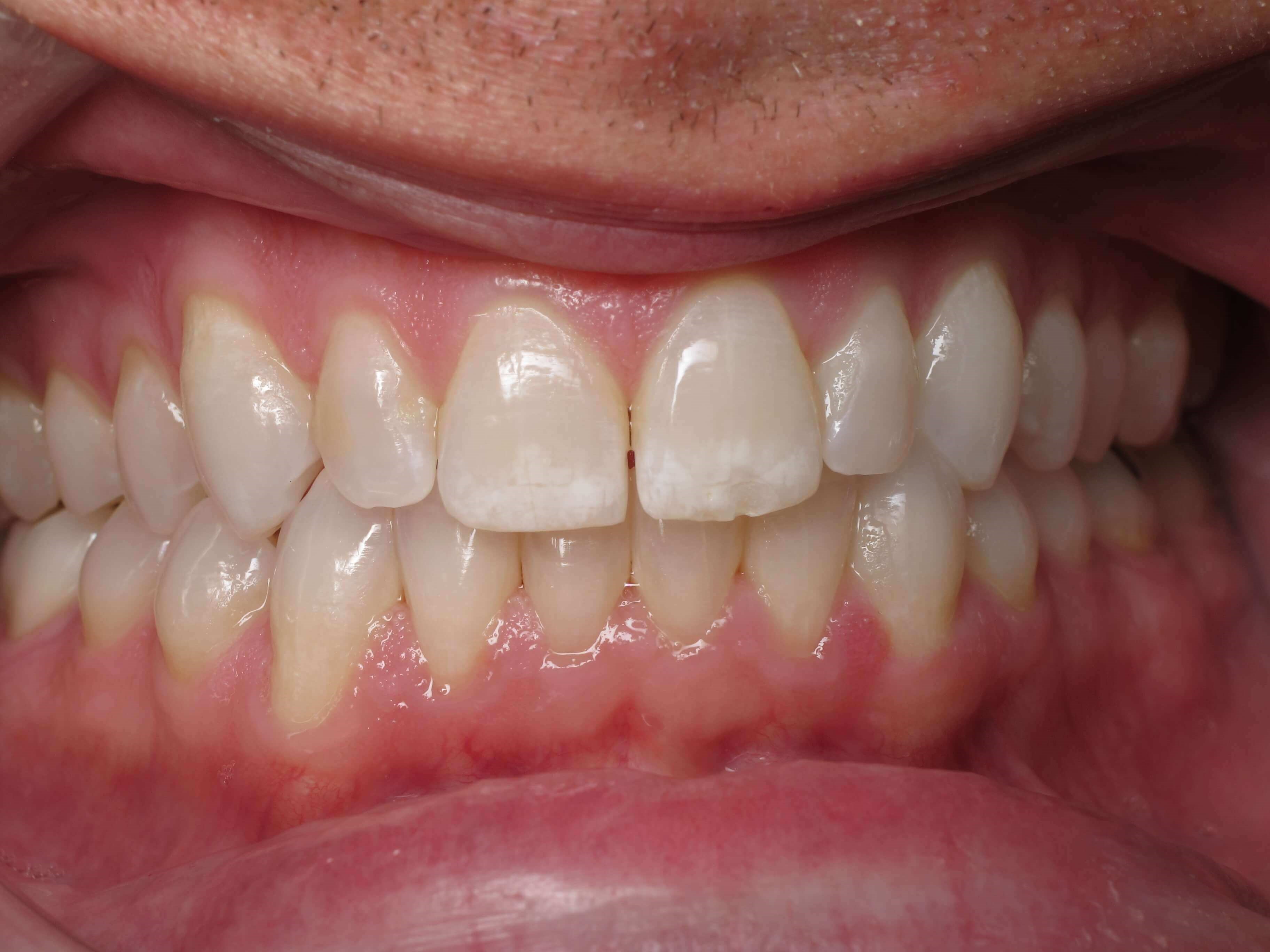 Smile makeover Before