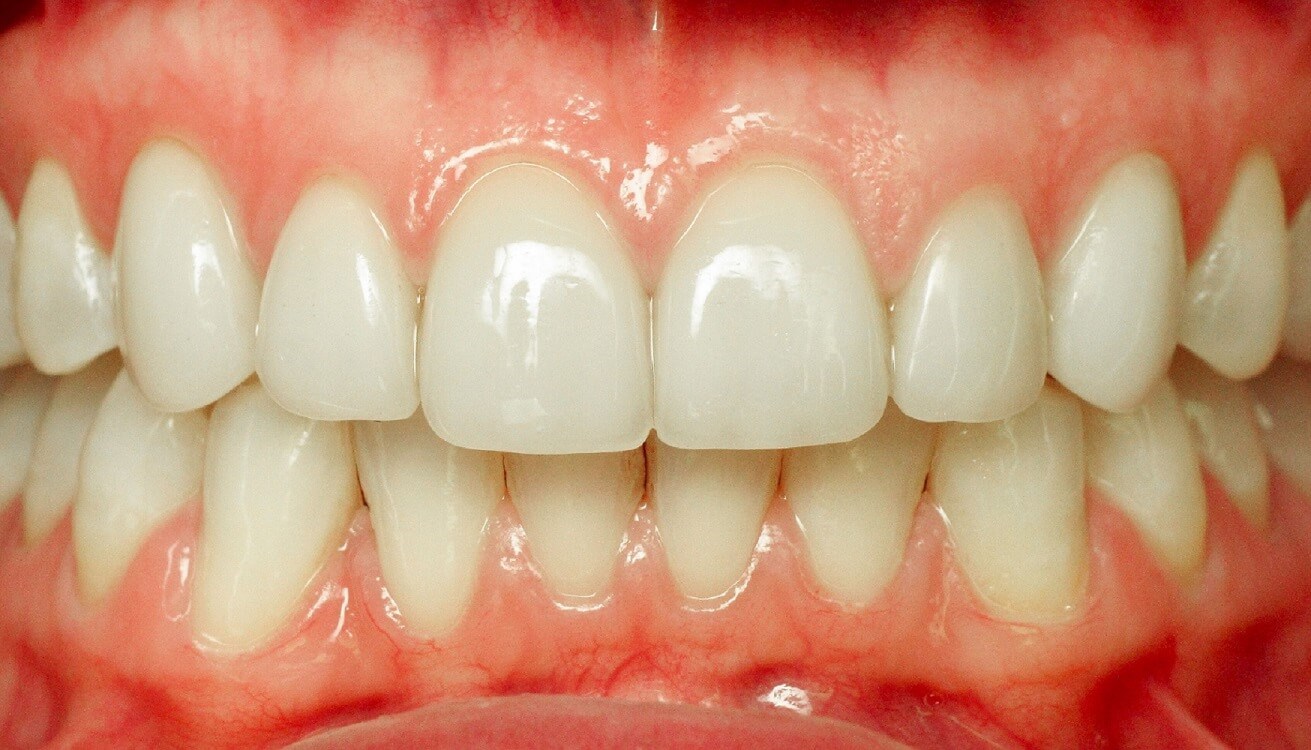 Smile makeover After