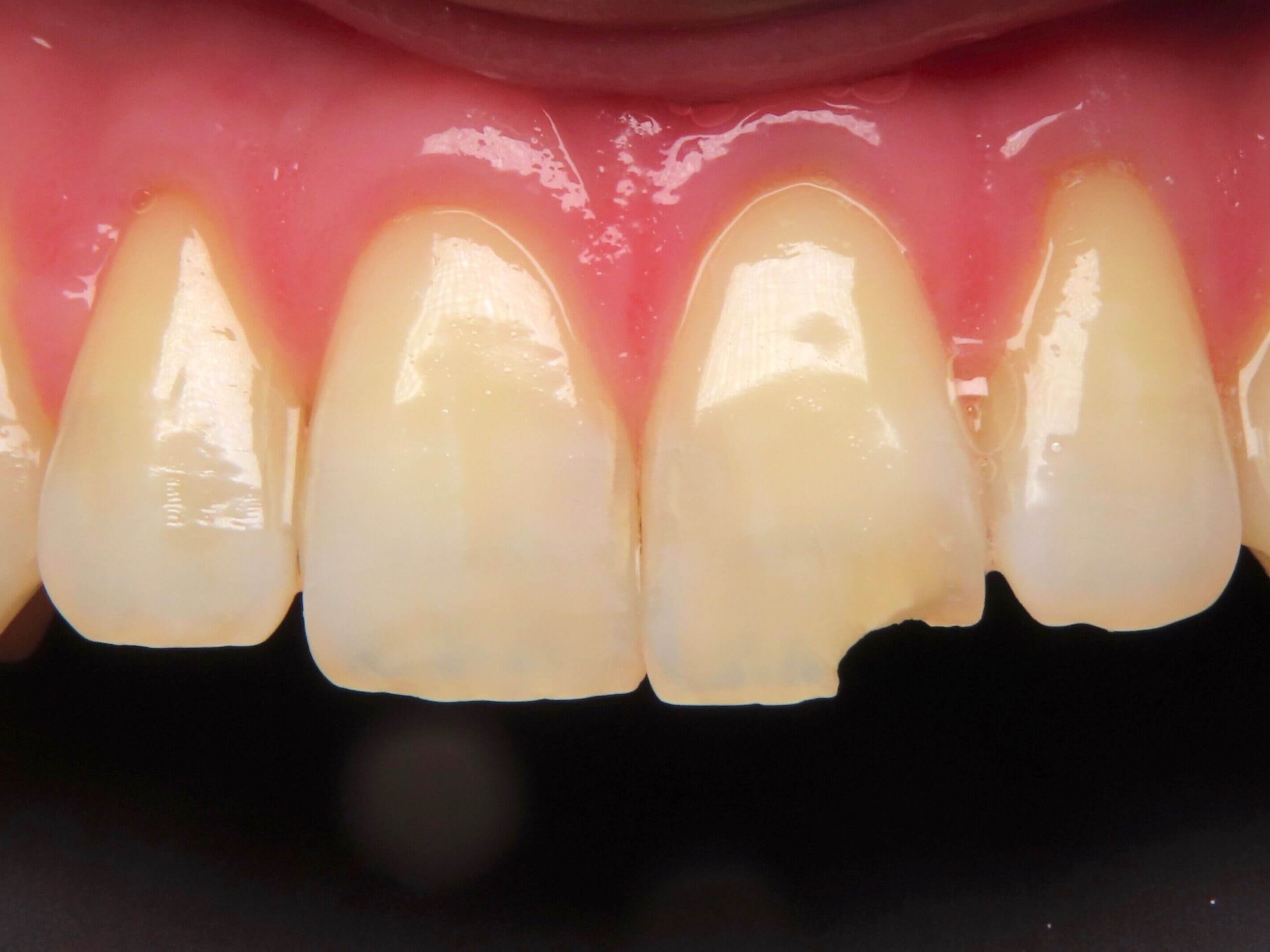 Single tooth Porcelain crown Before