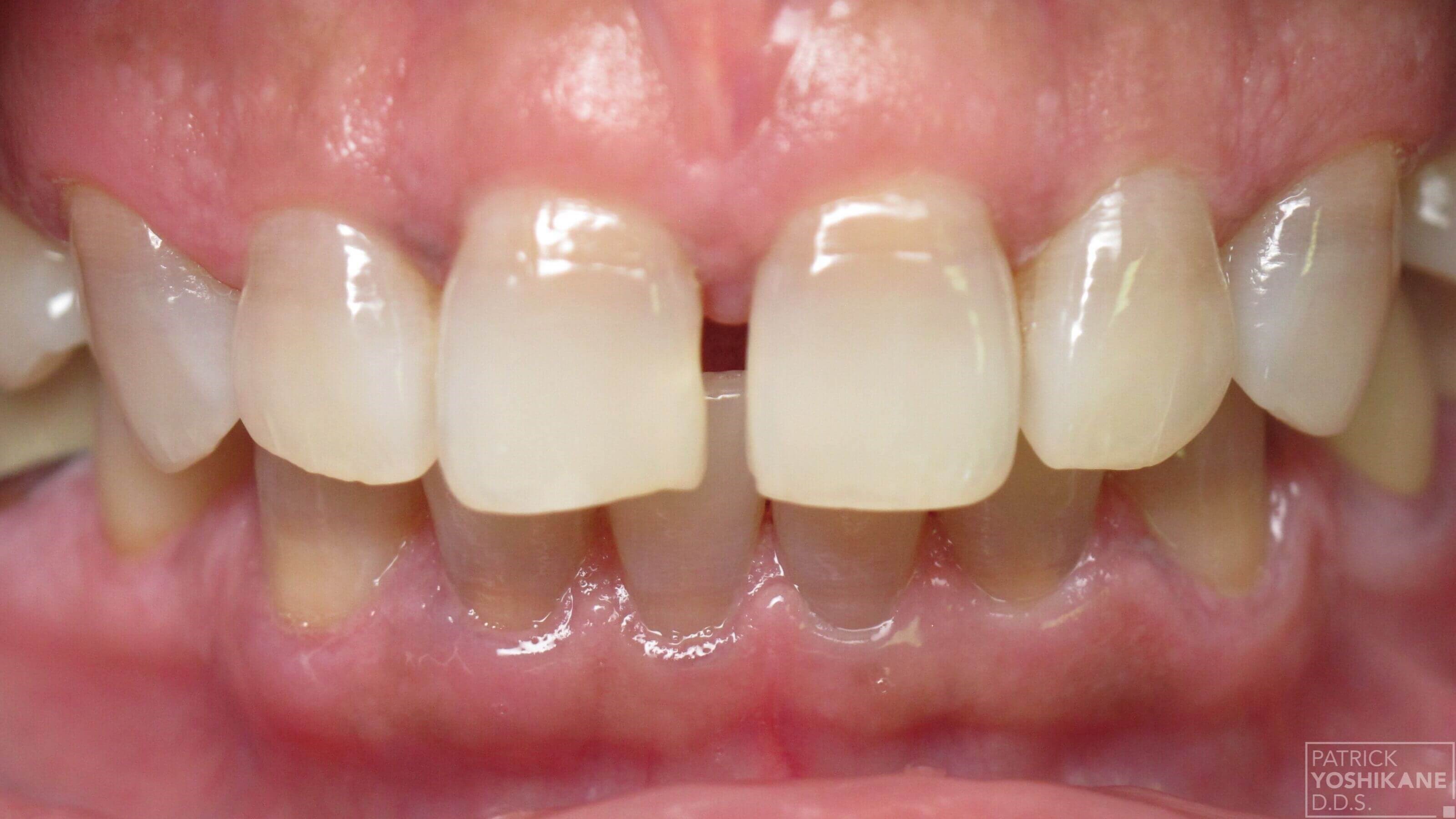 Front view before & after Before