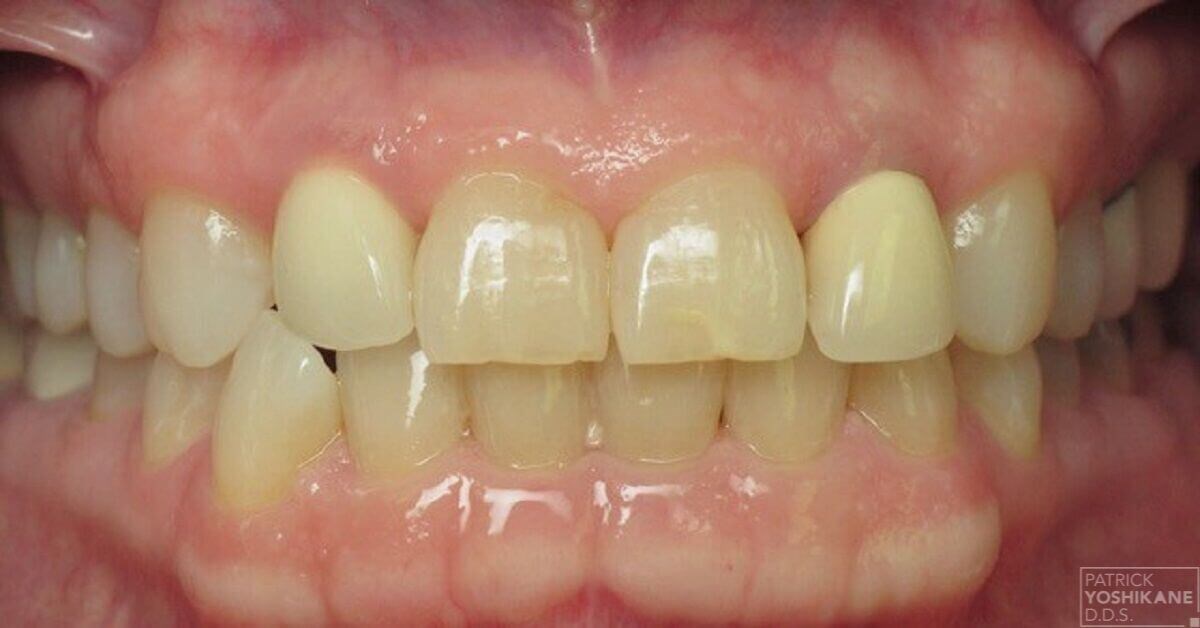 Smile makeover in Orange, CA Before