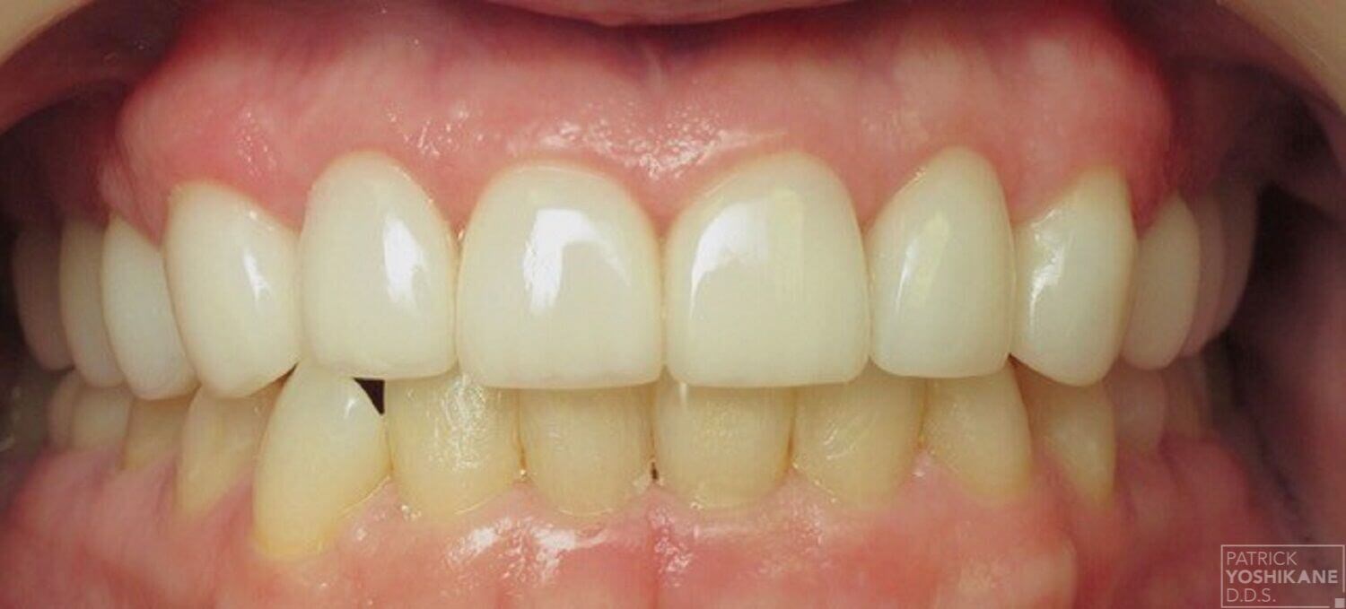 Smile makeover in Orange, CA After