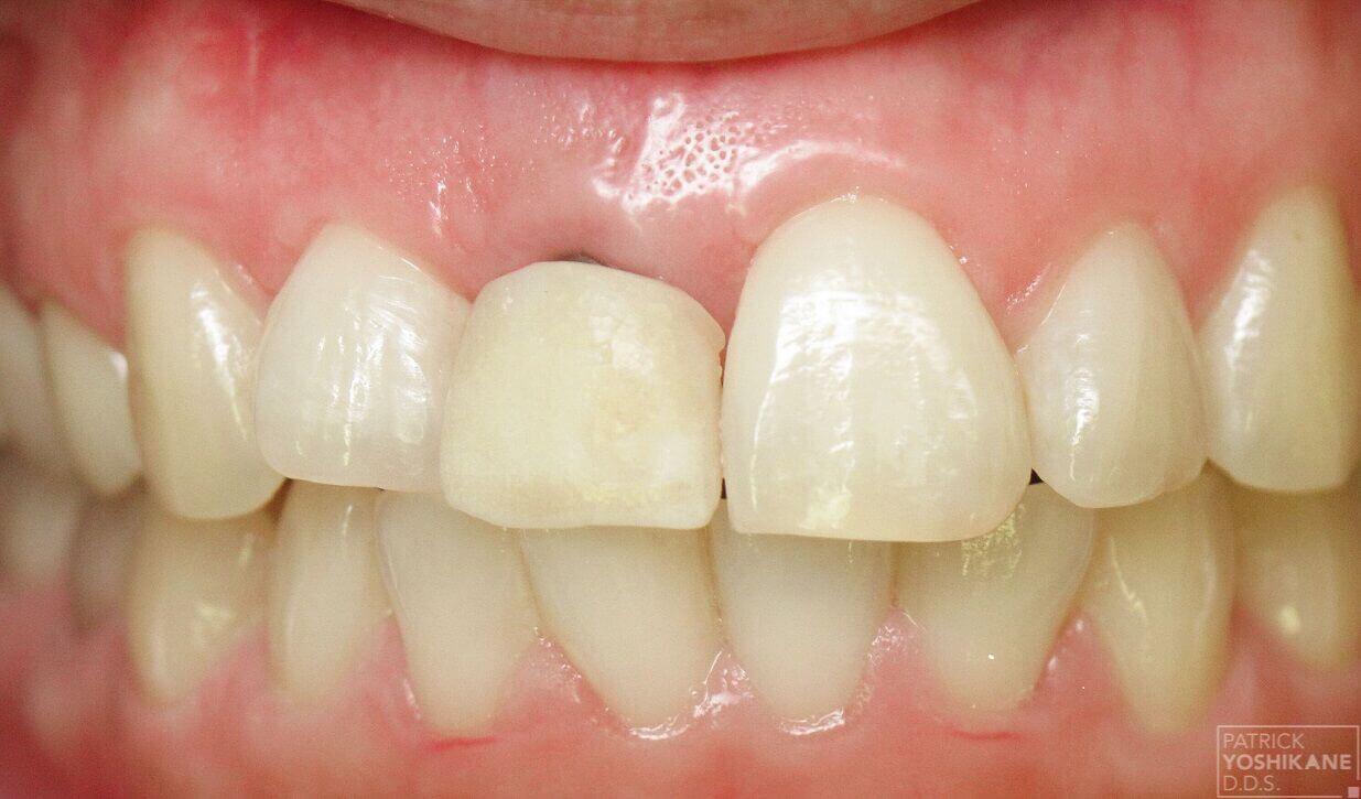 Front tooth implant crown Before