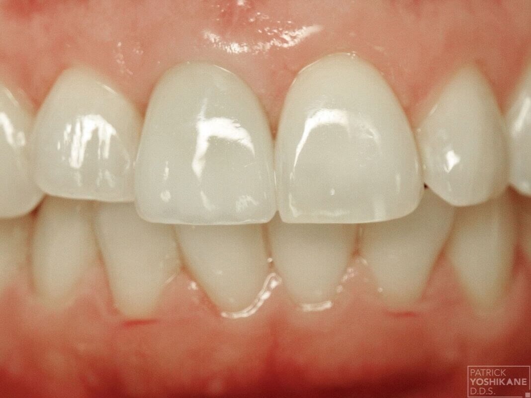 Front tooth implant crown After