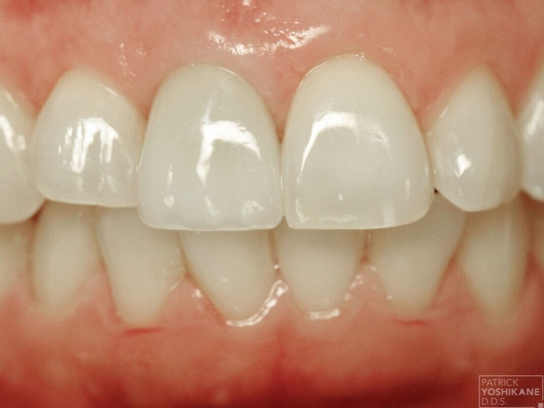 Front tooth implant crown After