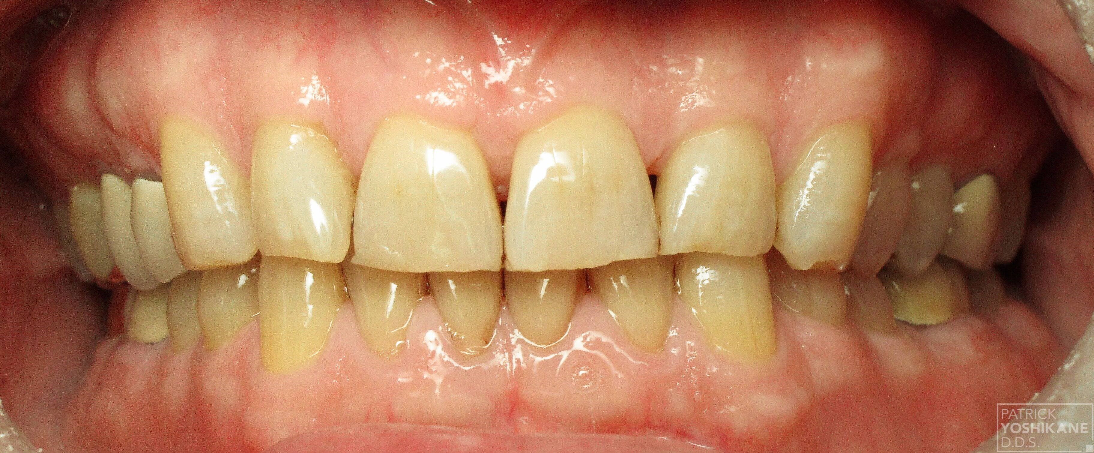 Full Mouth Reconstruction Before