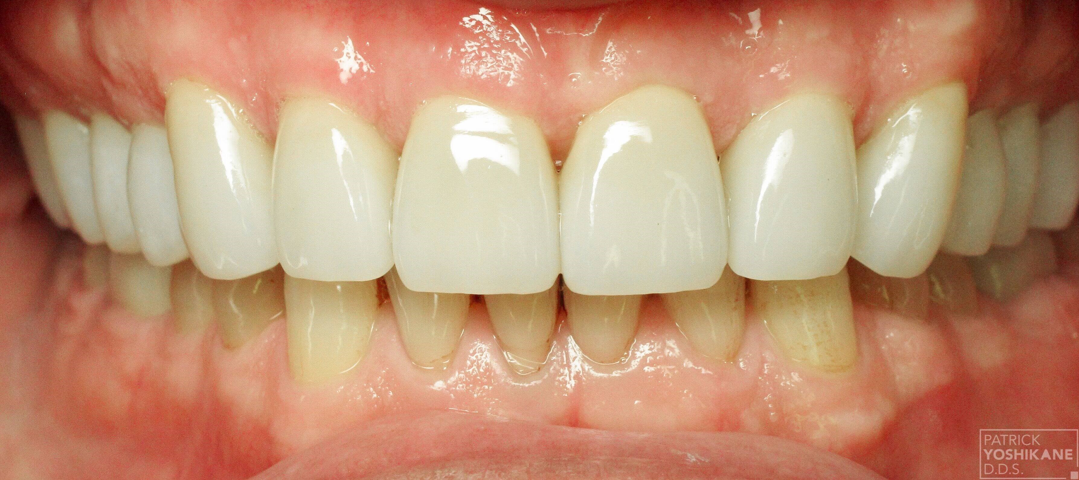 Full Mouth Reconstruction After