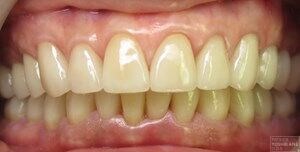 Front view before & after After