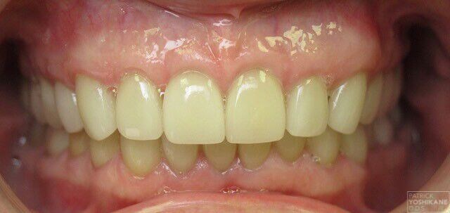 Front view before & after After