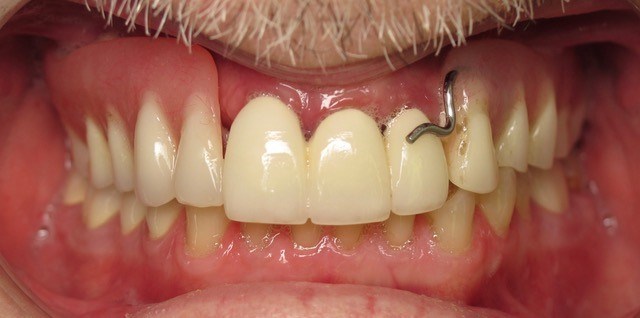 Smile makeover Before