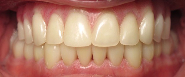 Smile makeover After