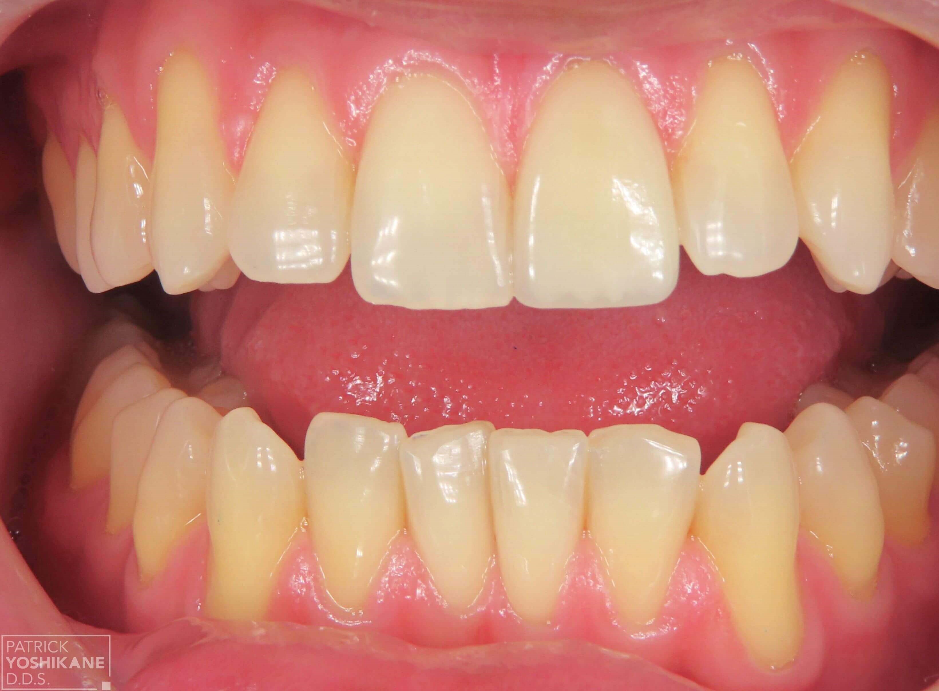 Single tooth Porcelain crown After
